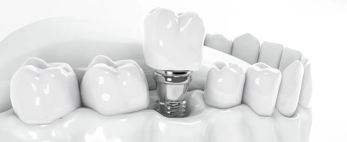 Oferta implantes dentales en Madrid Dentiopia